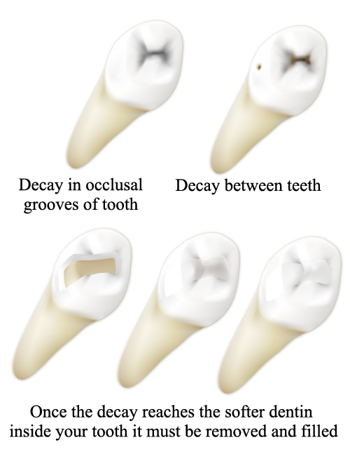 Cavities
